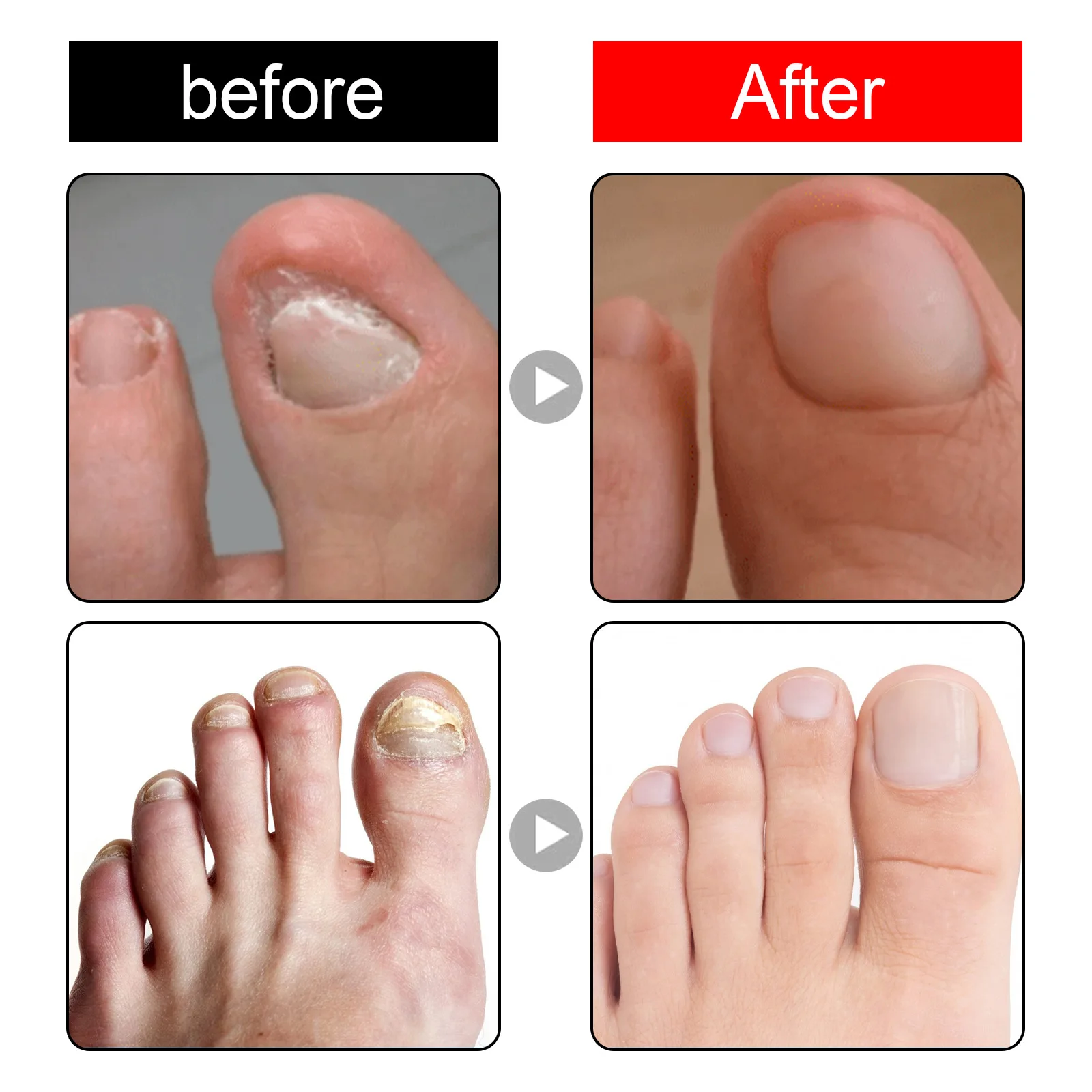 Nail fungal Treatment Serum Foot Fungus Remedy Removal Products Anti Infection Onychomycosis Paronychia Repair Gel Care 30ml