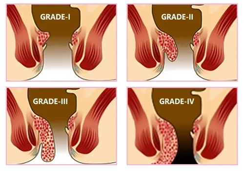 Diode  surgery 980nm hemorrhoids piles buasir hemorrhoid fistula ablation proctology