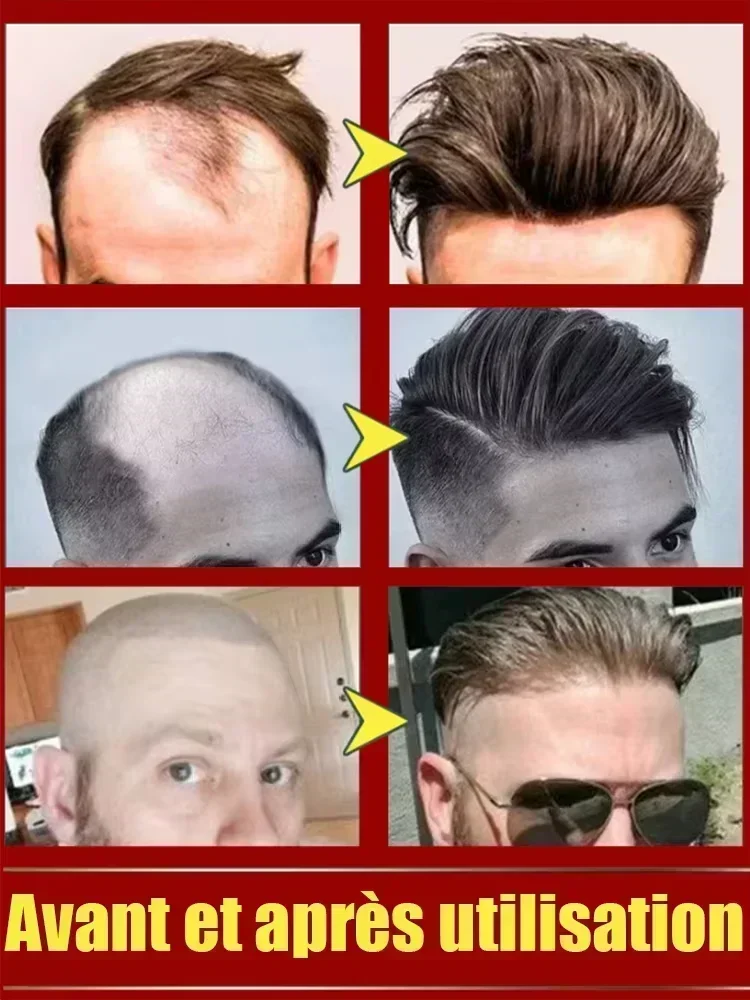 Hot sale, buyers will buy again, hair is getting more and more, say goodbye to baldness, sparse hair starts to become thick1