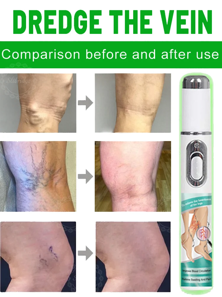 Eliminate vasculitis, phlebitis, relieve spider leg pain, varicose veins painless treatment view 3