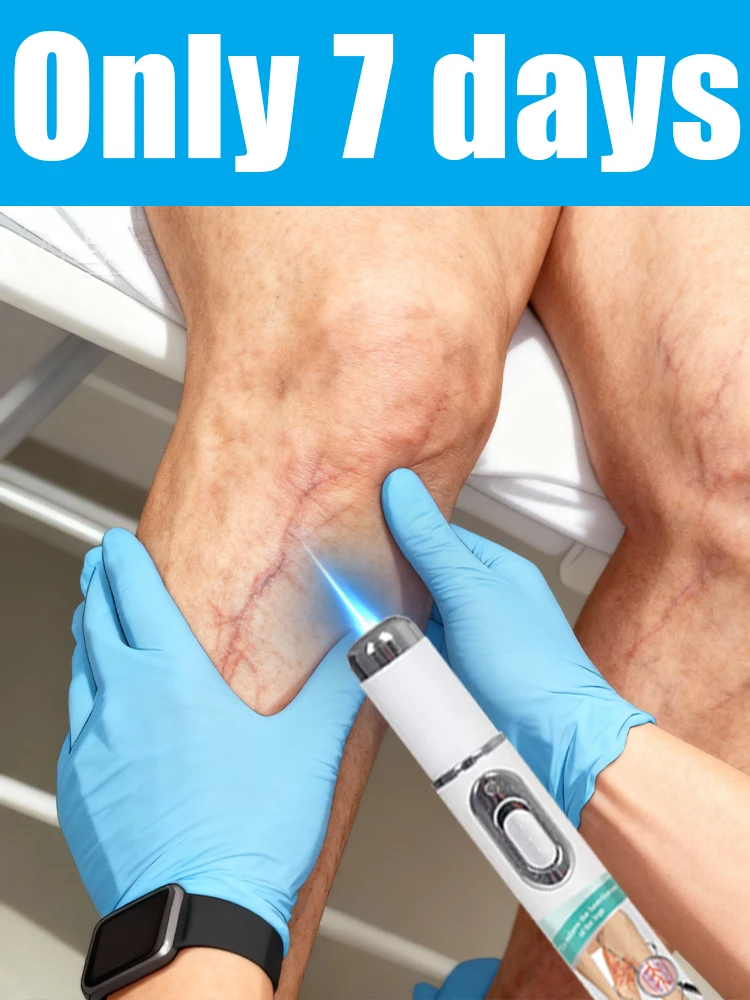 

2025 растворяют варикозное расширение вен теленка могут причинам дискомфорту и влияют на внешний вид Trouble