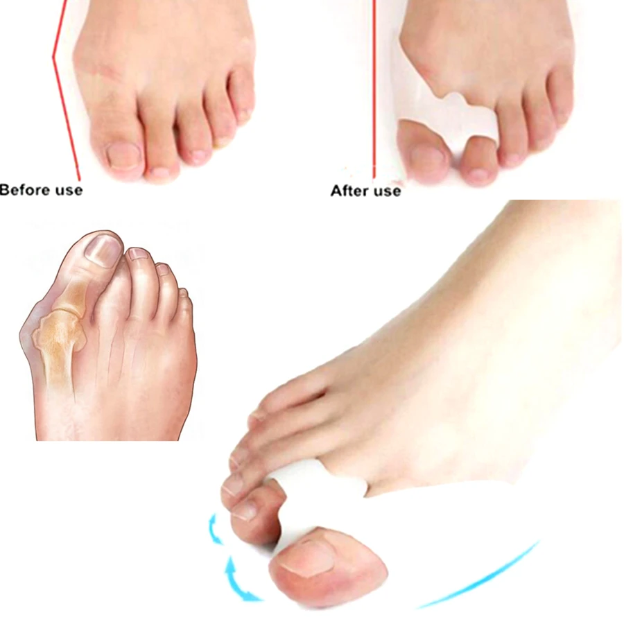 

Улучшенные Новые 2 шт. Набор инструментов для ухода за ногами: разделители-фиксаторы для пальцев ног (2 кольца), корректоры для выравнивания, облегчение боли при вальгусной деформации, регулируемые разделители