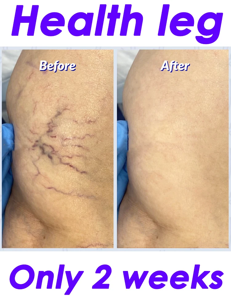 

Herbal Remedies Third Generation Varicose Vein Cream Relieves Spider Veins