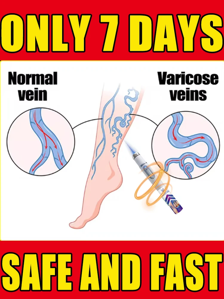 

Generation-2 Laser Says Goodbye To Spider Legs Varicose In 7 Days