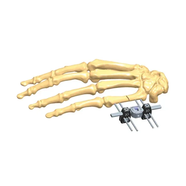 Application In Extra-articular Fracture Of Distal Ulna Mini External Fixator