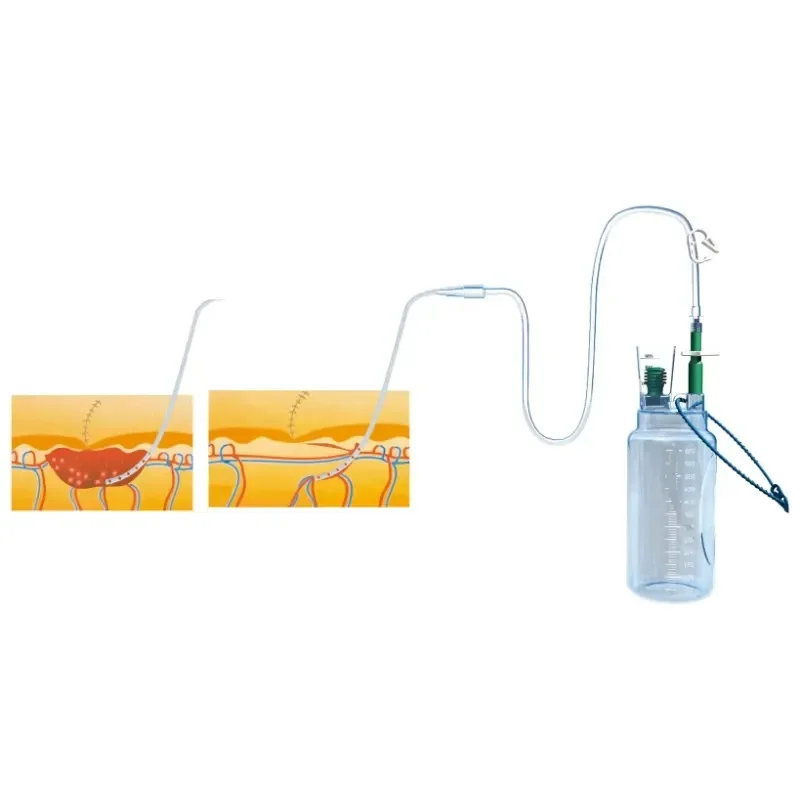 Chest Wound Drainage Instrument Set CD-330 Plastic Vacuum Sealing High Pressure Bottle for Thoracic Cavity Fluid Drainage Work