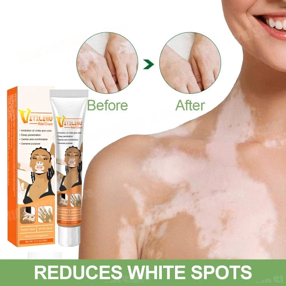 ᴴᴼᵀ Vitiligo care cream suitable for skin vitiligo white spots reduce spots