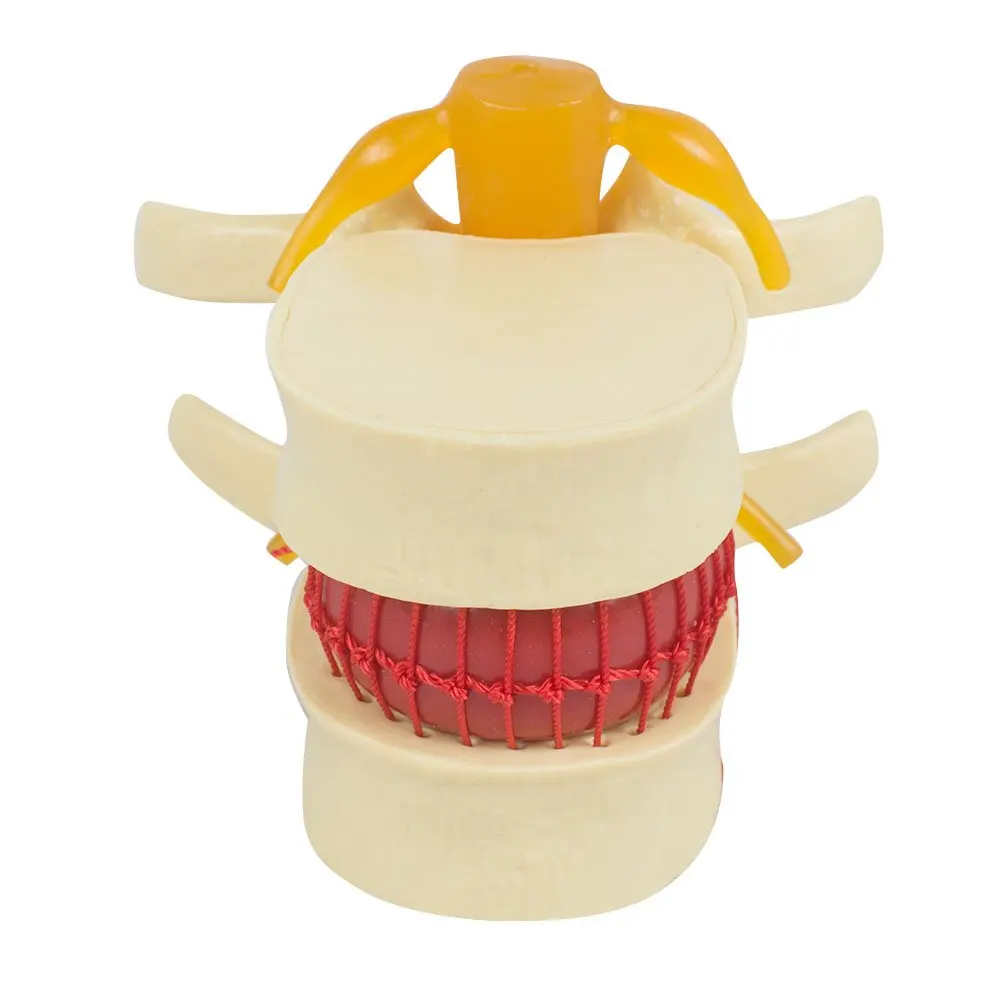 APHRODITE 1.5 Times Human Lumbar Disc Herniation Teaching Model of Lumbar Vertebral Spine Anatomical Models Soft Enlarge Yellow