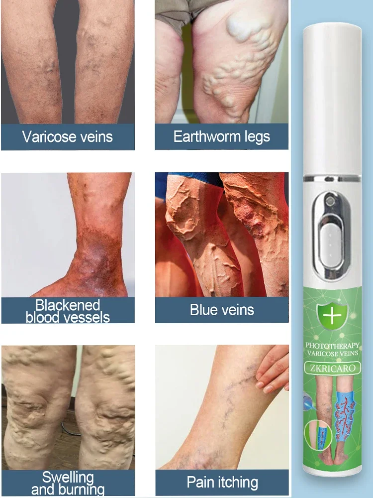 Powerful Laser Therapy for Moderate Varicose Veins, Relieve Pain and Improve Circulation for Both Men and Women