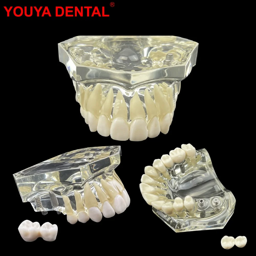 Maxillary Teeth Implant Model New Clear 4 Implants Restoration Dental Model With Removable Tooth For Studying Teaching Education