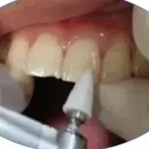 

Стоматологическая ионная полировка и отделка частиц кремния, шлифовальные головки, колесо для низкоскоростного гибочного станка для наконечников