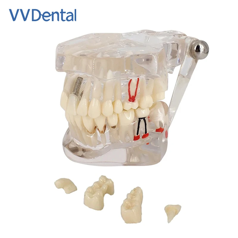 Removable Dental Model for Studying Implant Disease New Teeth Restoration Bridge for Dentist Teaching Demonstration