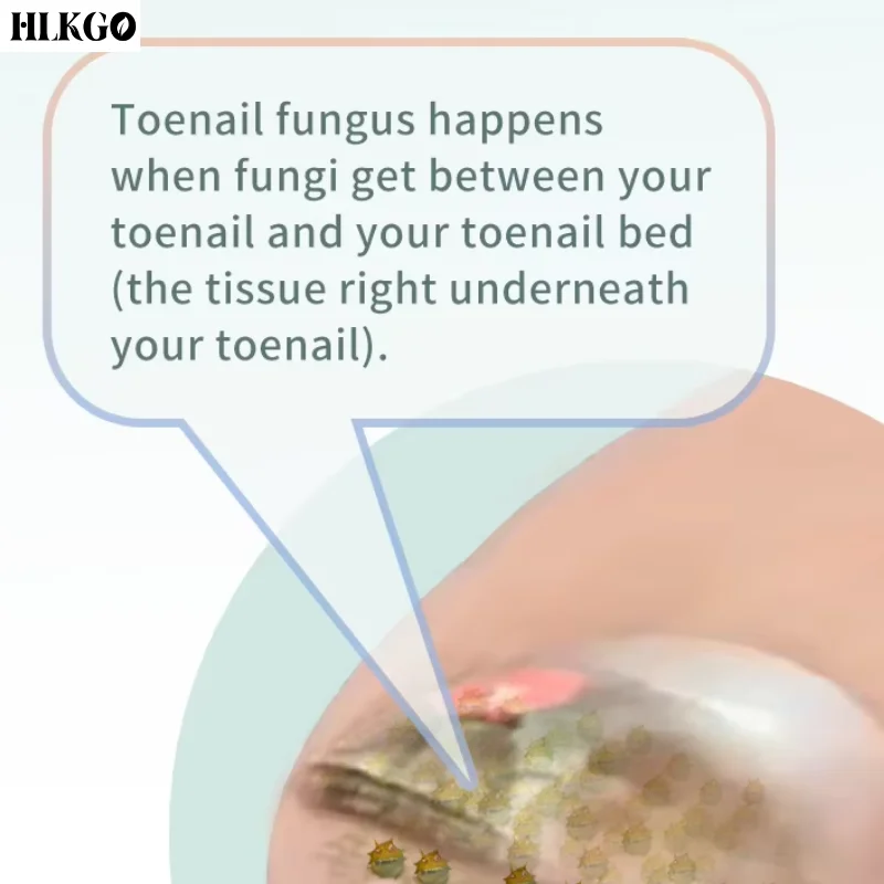 Nail Fungus Treatment Device Infrared 910nm Blue Light 470nm Laser for Toenail Infection Care and Nail Regrowth Support