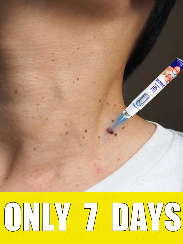 

blue light pen solve warts, hot sale wart care tools