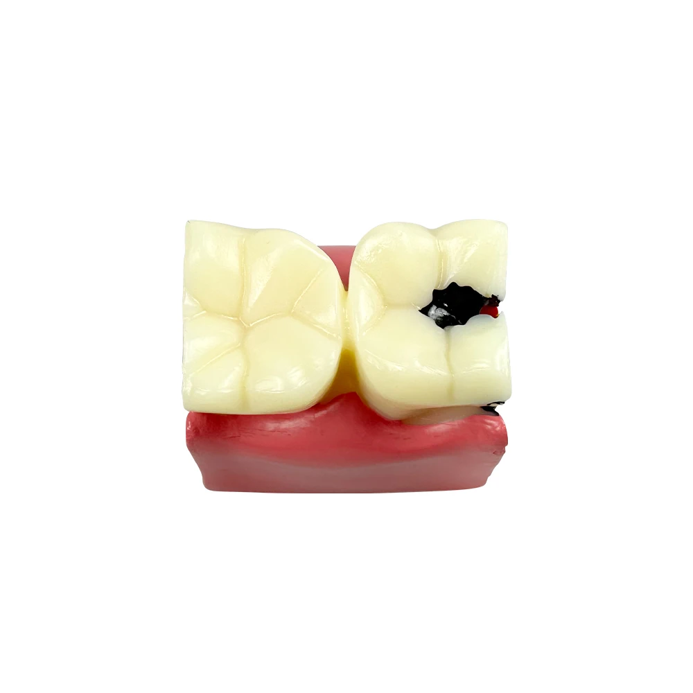 Dental Caries Comparsion Tooth Models 6 Times Study Models For Dentist Studying Teaching Anatomy Practice Dentistry Teeth Model