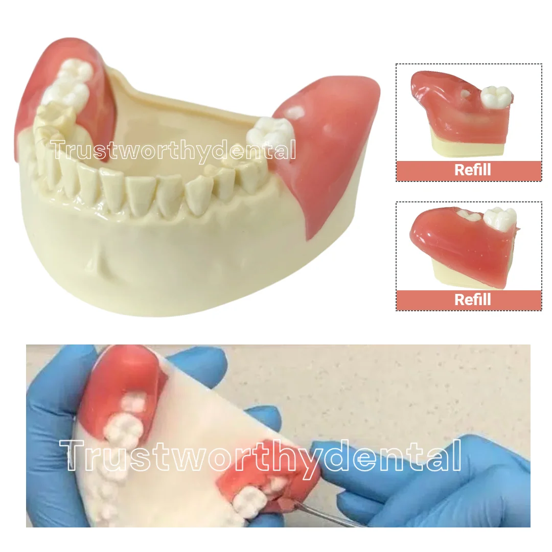 

Dental Impacted Tooth Extraction Model Block Wisdom Teeth Removal Suturing TechniquesPractice Model Training Extract WisdomTeeth