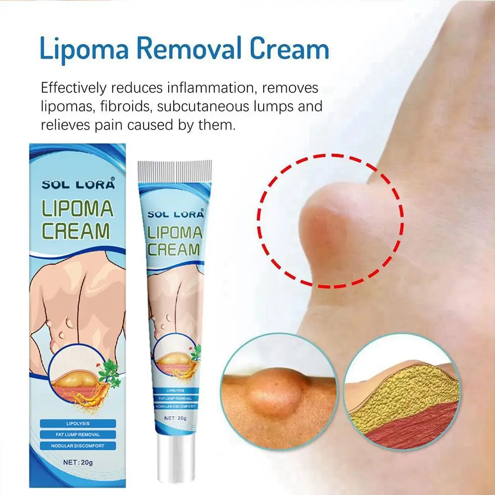 Lipoma Removal Cream Lipolysis Fat Lump Relief Plaster Skin Swelling Fat Elimination Cream Drop Shipping 20g Health Care