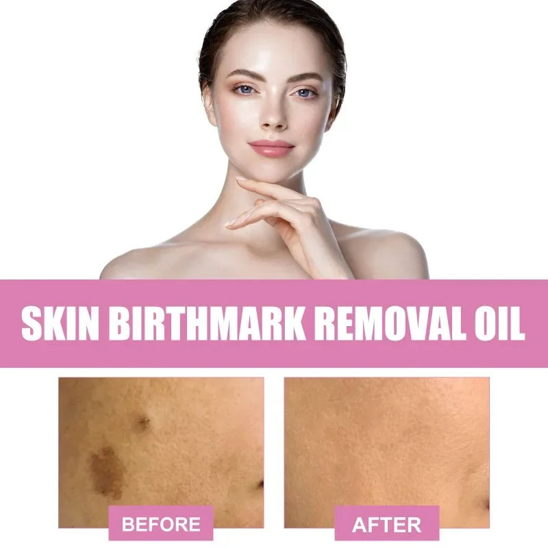 Pele e Birthmark Remoção Soro, Anti Freckle, Pigmentação desvanecer-se, Melasma Hidratante, Clareamento, Clarear Face Care, Essence Oil