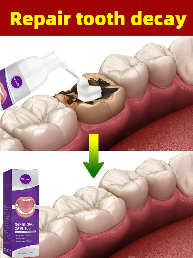 Riparazione della carie dei denti