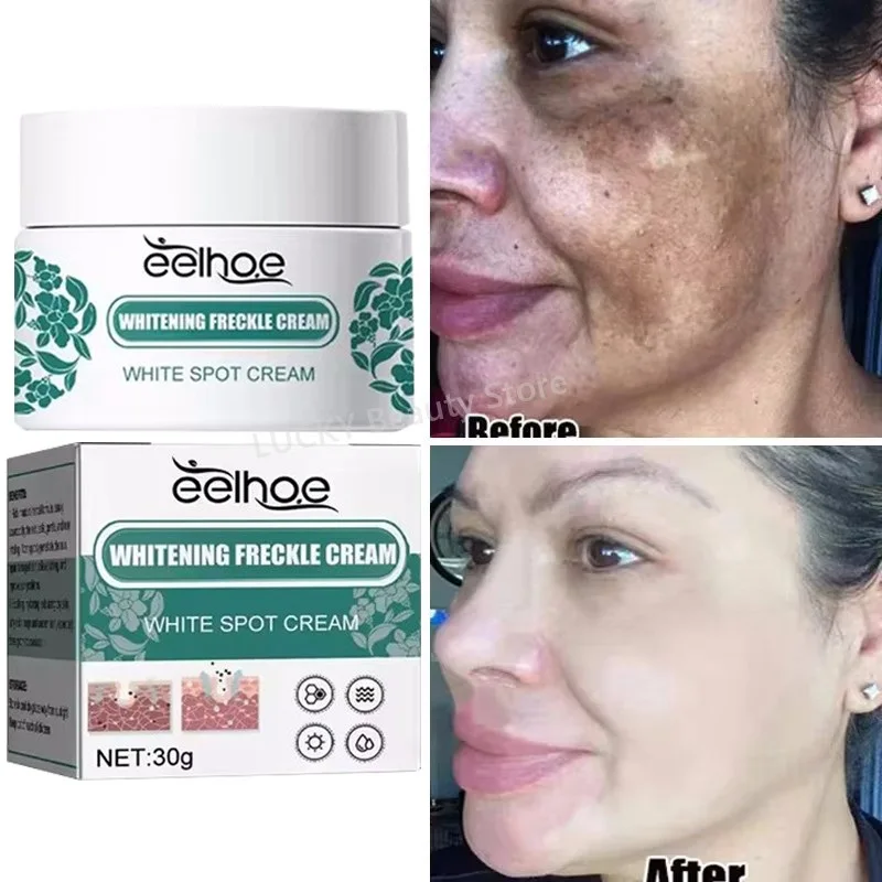 Crema iluminadora de niacinamida, Melasma, Reduce la melanina, aclara la piel oscura, suero Chloasma, desvanece las líneas finas, productos para el cuidado facial coreano