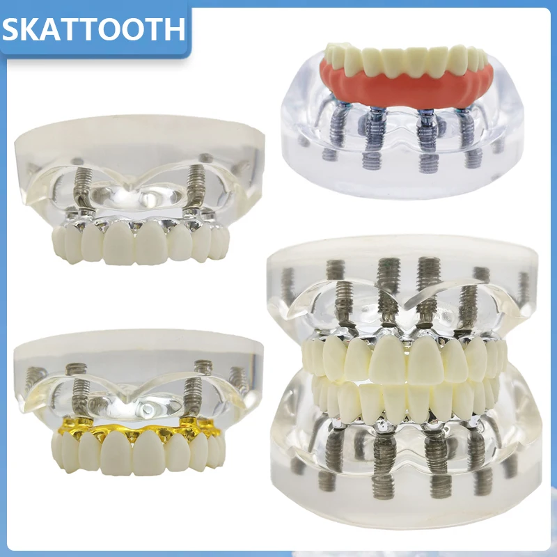 Dental Implant Model Transparent Upper/Lower Jaw 4/6 Implants Overdenture Restoration Teeth 4/6 Removable Screws Dental Demo