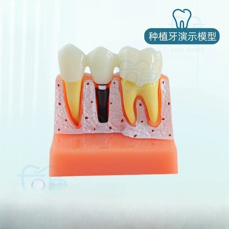 Dental implant model 4x implant solution model, denture restoration dental implants, removable, connecting bridge crowns