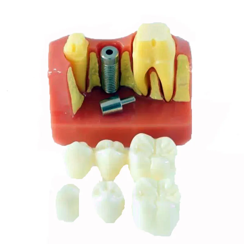 

4 Times Dental Implant Model for Education Tooth Anatomical Medical Science Teaching