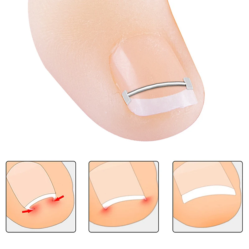 Profissional correção de unhas encravadas ferramenta de cuidados com os pés ferramentas corretor de unhas encravadas pedicure recuperar incorporar