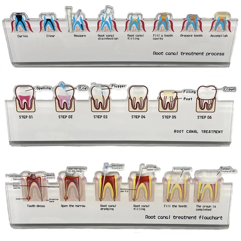 Dental Model Teaching Models Doctor-Patient Communication Models Root Canal Treatment Flowchart Stand Implant Model Dentist Gift