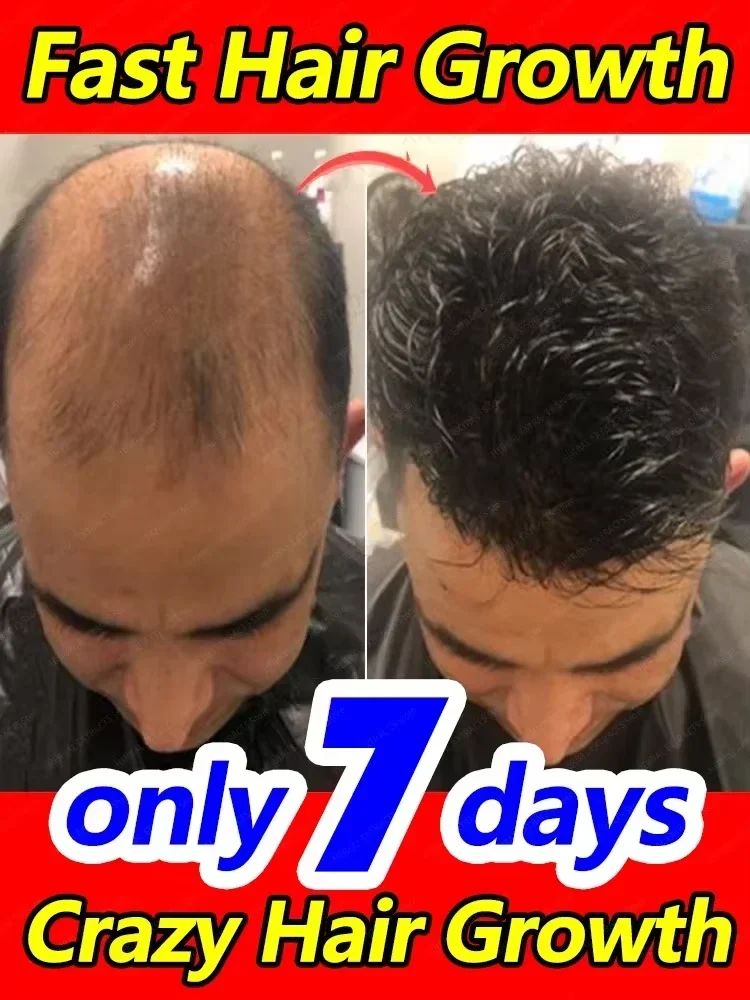 Óleo de crescimento do cabelo crescimento rápido do cabelo eficaz reparação da calvície perda de cabelo hereditária pós-parto pe