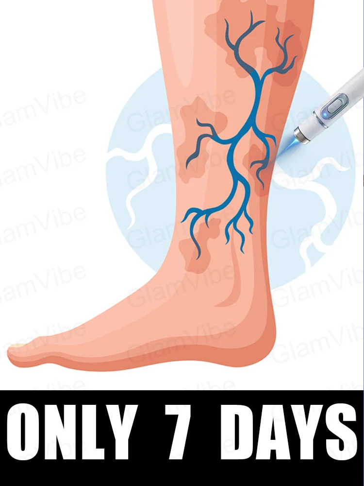 

Generation-2 Laser Says Goodbye To Spider Legs Varicose In 7 Days