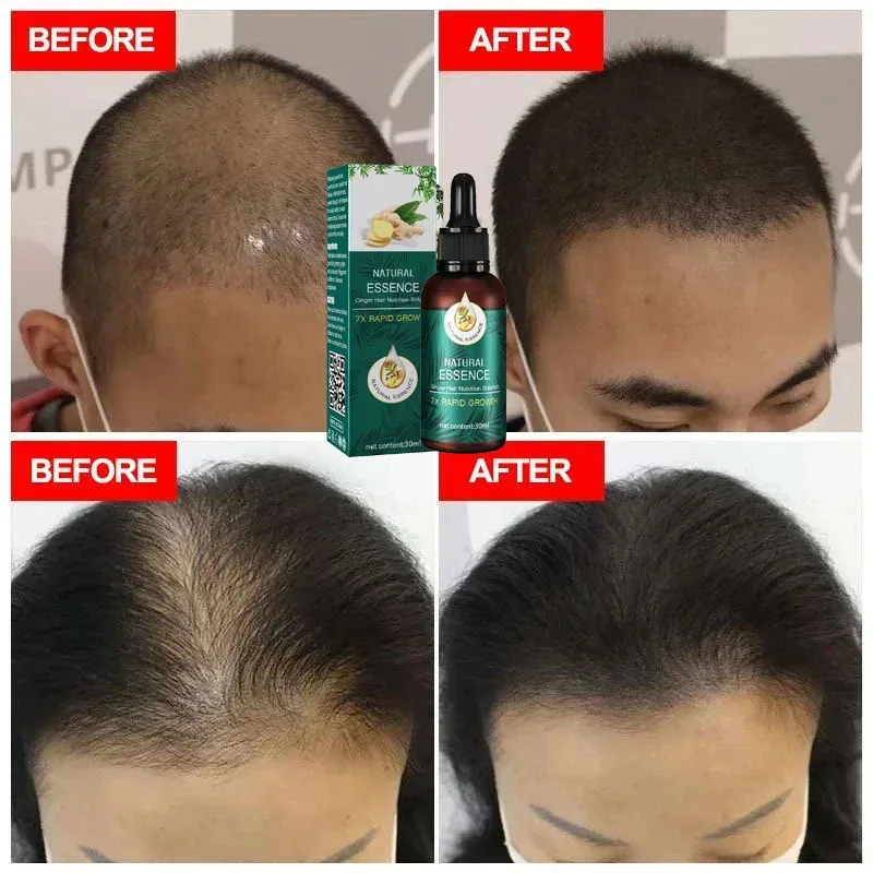 Óleo Essencial De Crescimento Rápido Do Cabelo Natural De Gengibre, Regrowth Do Cabelo, Produtos Resistentes Fortes, Soro, Anti Hair Loss Care Series, Série