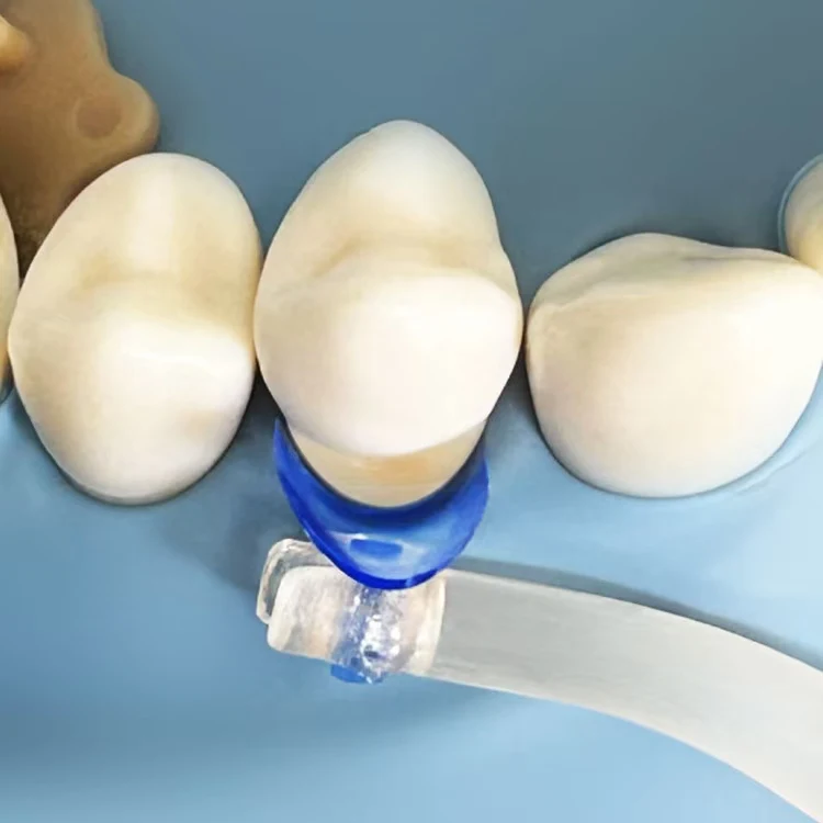 102 Stück/Set Dentalmatrizen, blau transparent, zervikale Matrizen, Matrizenbänder für Komposit, Zahnfüllmaterialien, Zahnarztwerkzeuge – Detail 4