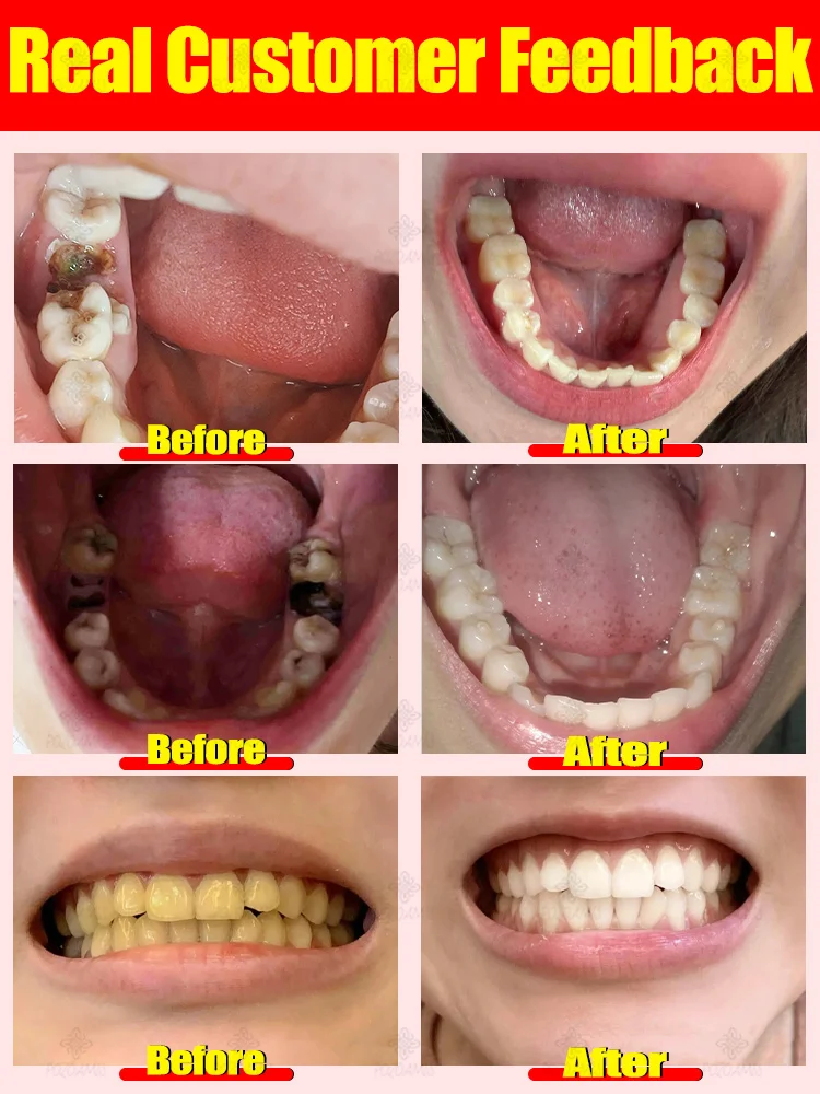 Cavity Repair Tooth Decay Treatment Toothpaste