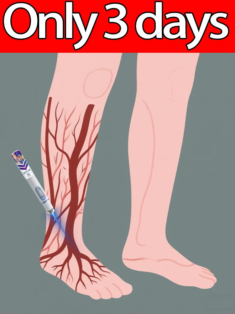 

Vᴀʀɪᴄᴏsᴇ ᴠᴇɪɴ ʟᴀsᴇʀ ɪɴsᴛʀᴜᴍᴇɴᴛ