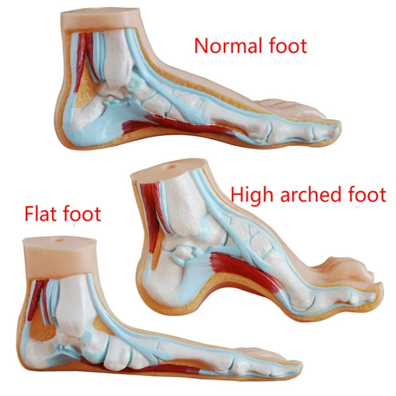 Medical Human  Sketelon  Flatfoot, Arch Foot and Normal Foot Anatomy Model with Muscles and Joints for Educational Purposes