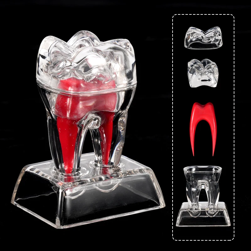 Large Tooth Molar Model Separable Teaching Demonstration Model Transparent Dentistry Material Dental Lab Teeth Model