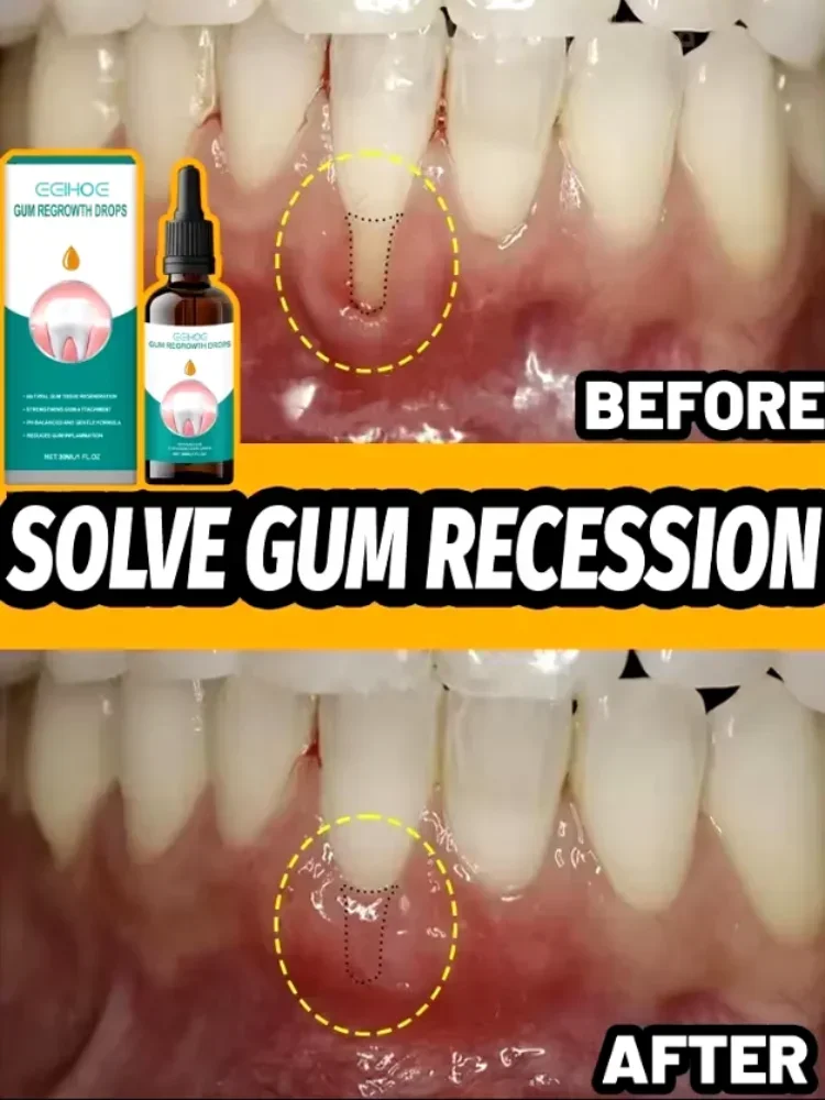 Gum Repair Drops Relieve Receding Gingival Swelling Gum Cleaning Care Oral Periodontal Hygiene Remove Stain Remove Yellow Tartar