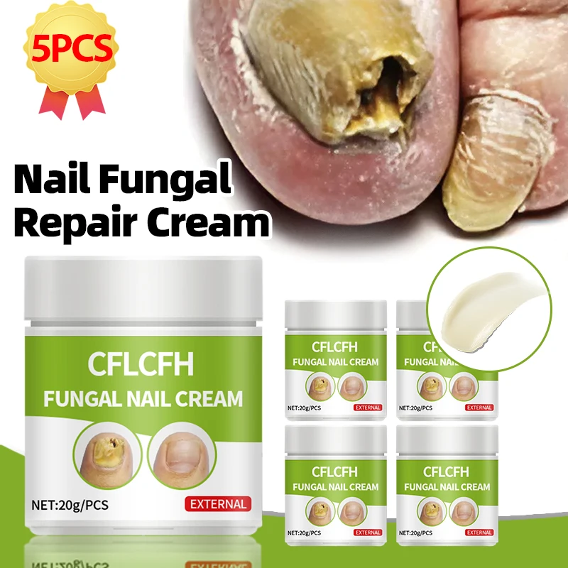 Nail Fungus Treatment Cream Offers Toe Paronychia Relief and Onychomycosis Therapy,and Ingrown Toenail Removal Plaster