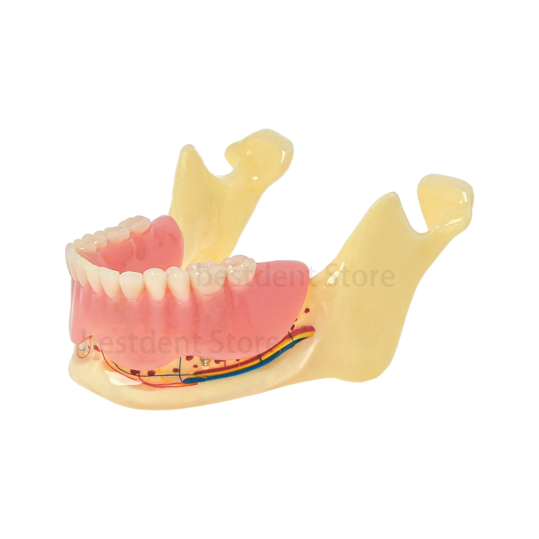 

Dental Implant Teeth Model Lower Jaw Removable Model 4 implants demo Position and Direction