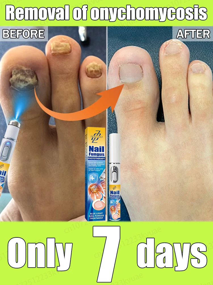

Restore your nails to normal. Say goodbye to onychomycosis.