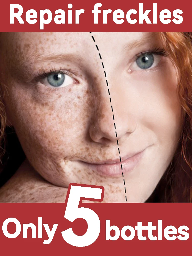 

An effective facial freckle cream that removes freckles and solves the freckle problem that has existed for many years