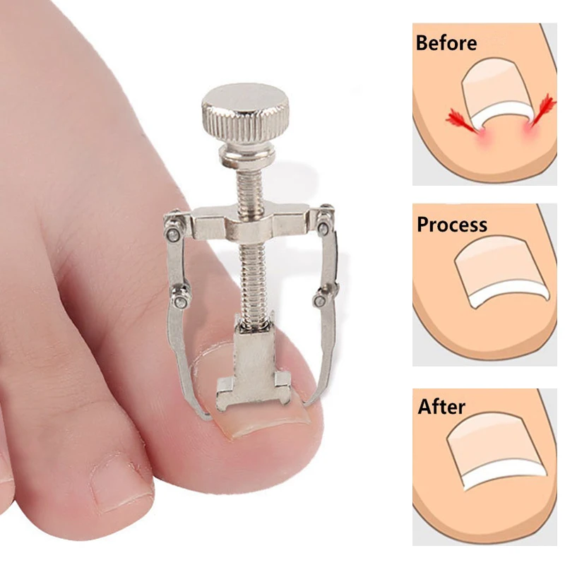 Ingrown Toe Pedicure e Pé Nail Care Corrector, Manicure Ferramentas para Pés, Orthotic Acronyx, Onyxis Bunion Corrector