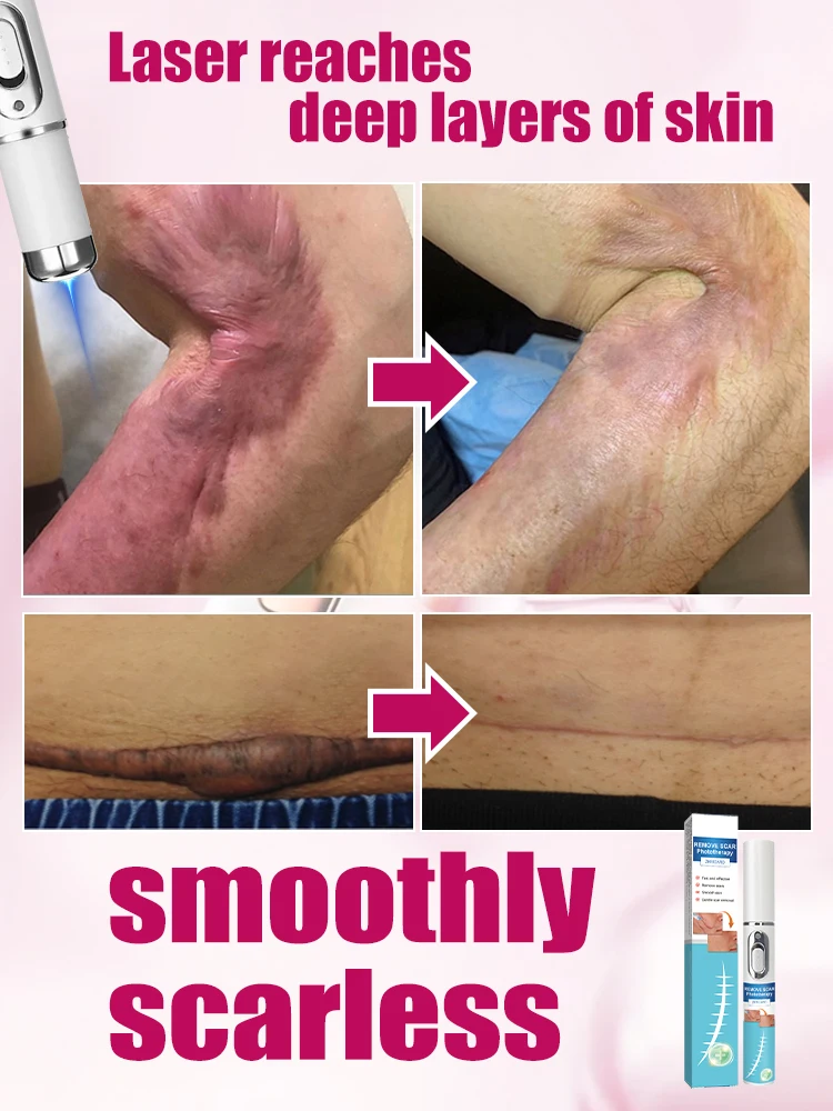 

Advanced laser treatment for long-term and hypertrophic scars