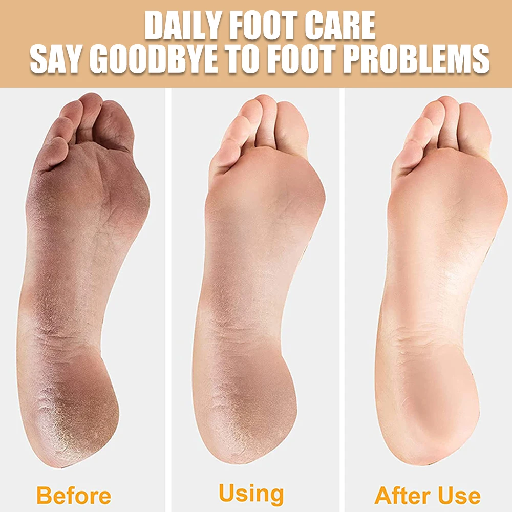 Lima de pie de doble cara, rallador de talón profesional, eliminador de callos de piel muerta dura, Lima de pedicura, 1/2/3/4/5 Uds.