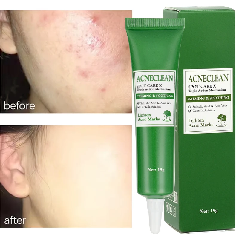 

Centella Asiatica Acne Remove Cream Face Acne Repair Gel Oil Control Aloe Vera Moisturizing Smooth Skin Care Korean Cosmetics