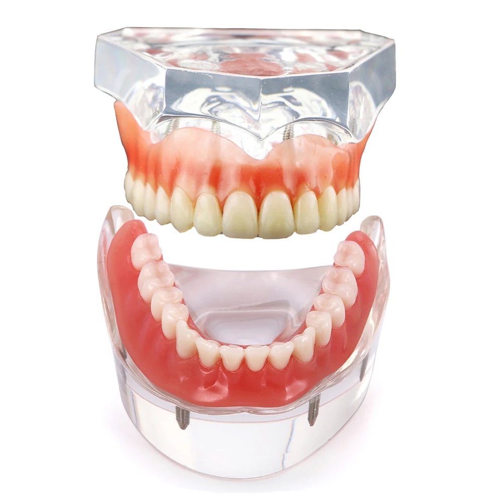 

Dental Teeth Model Dental Implant Overdenture Model Upper Lower Mndibular Model For Dentist Patient Communication Demo