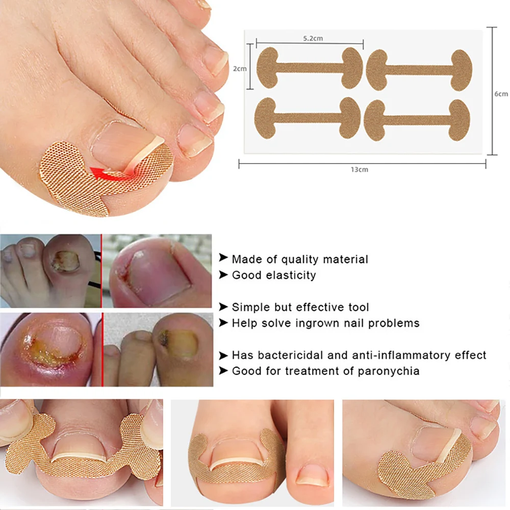 Pexmen 4/20/30/50Pcs Toenail Corrector Patch Nail Patches Ingrown Toenail Corrector Sticker Ingrown Toenail Treatment