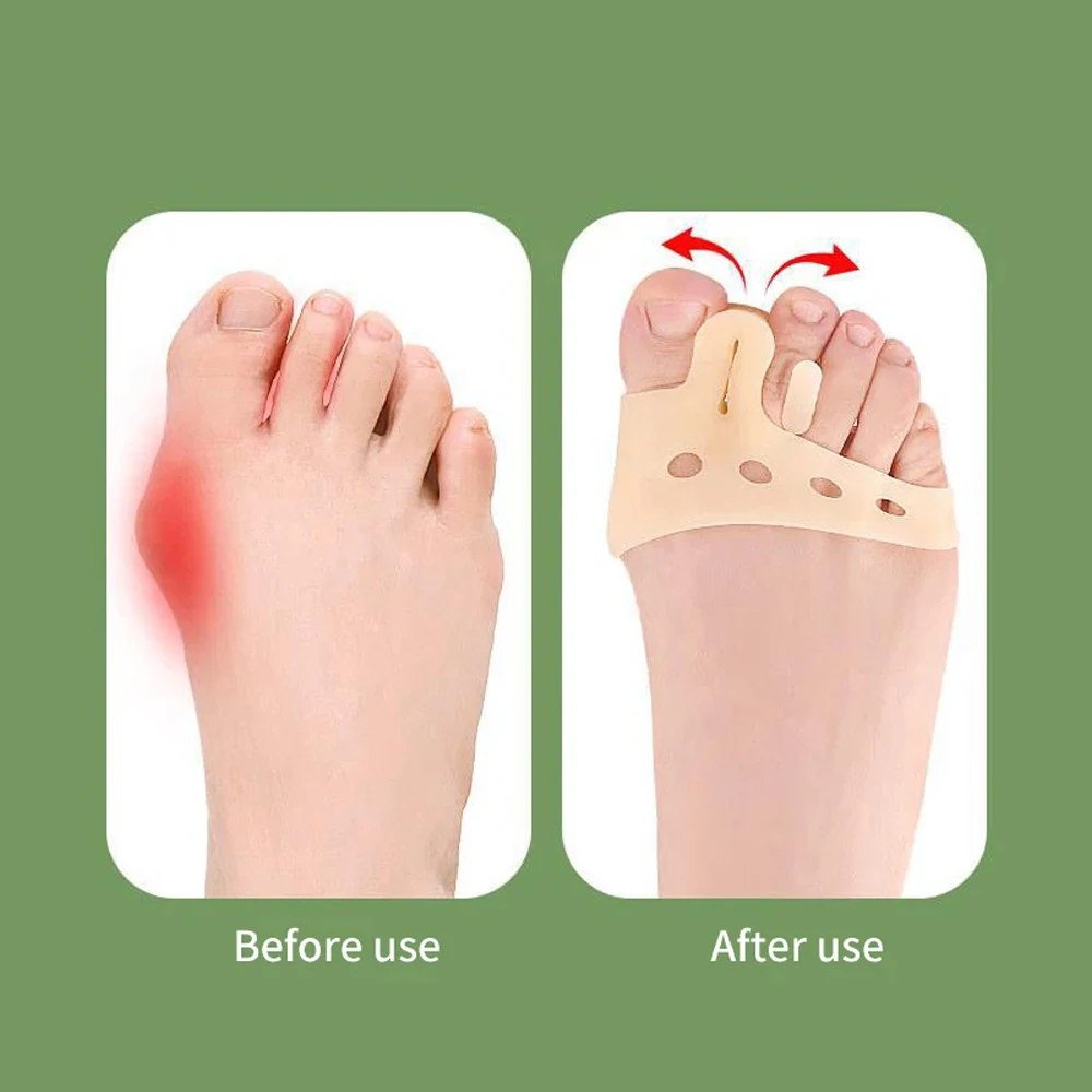 Pemisah jari kaki besar untuk pria dan wanita, bantalan lengkungan silikon, alat perawatan kaki, Bunion, palu jari kaki, nyeri Metatarsal, 1 pasang