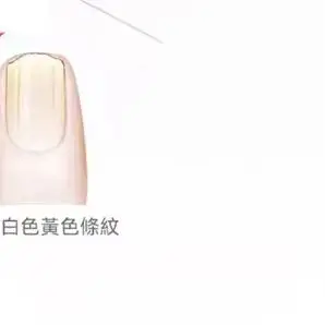 

Non-Invasive Nail Fungus Treatment Laser - 470nm 905nm Light Device for Toenail Fungus Infection Healing Care